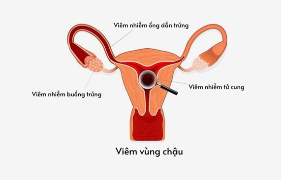 viêm nhiễm vùng chậu