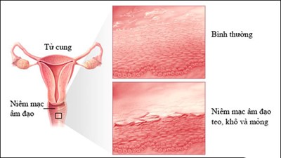 viêm teo âm đạo